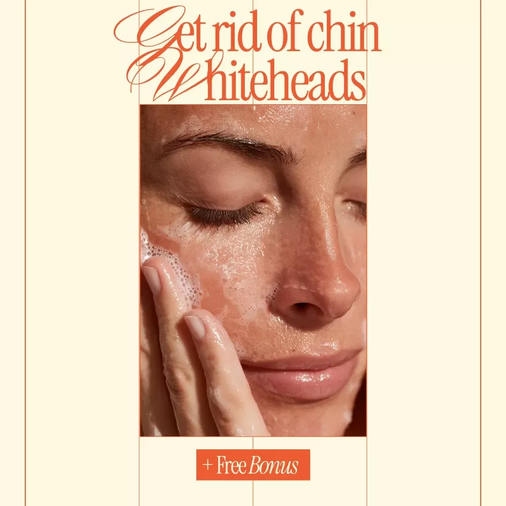 Get Rid of Chin Whiteheads – Clear Skin Routine, Targeted Treatments & Prevention